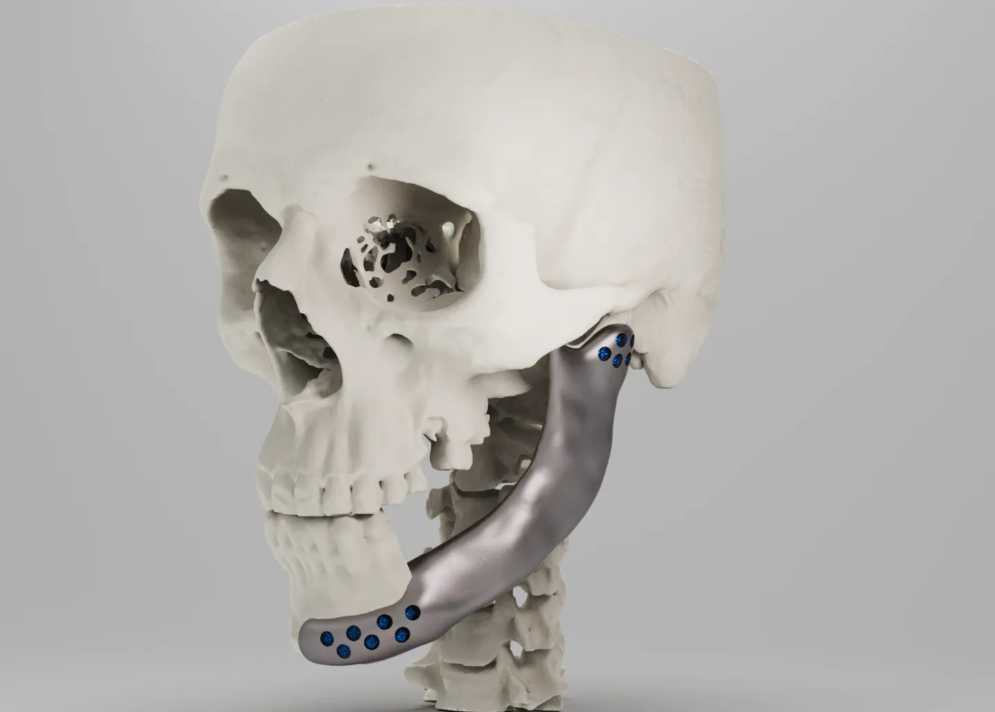 Reconstrucción mandibular a medida en titanio, diseñada a partir de la tomografía del paciente
